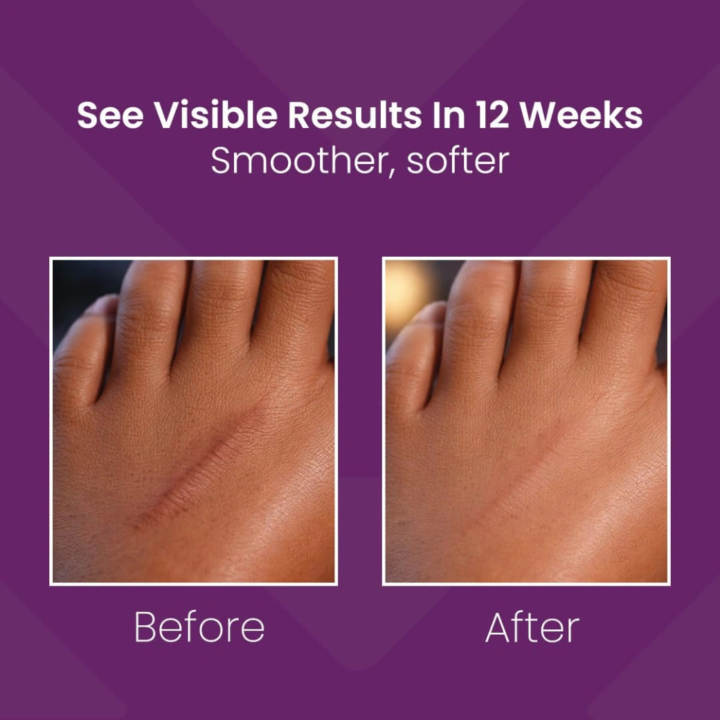 Mederma Skin care For Scars - 20g
