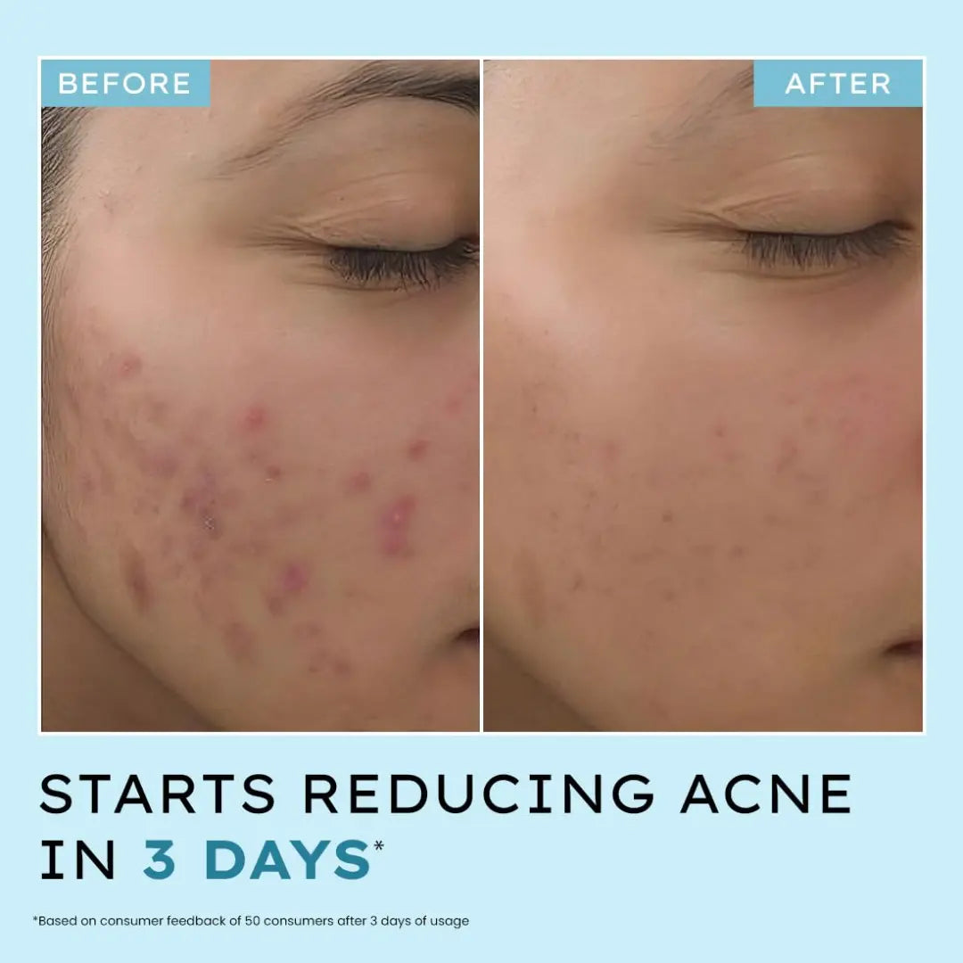 Hyphen Acne Defence Daily Serum For Acne Prone Skin with Salicylic acid 2%, Azelaic Acid 10%, Niacinamide 4% | Treats Active Acne, Controls Oil | AntiAcne Serum for Men & Women- 30 ml