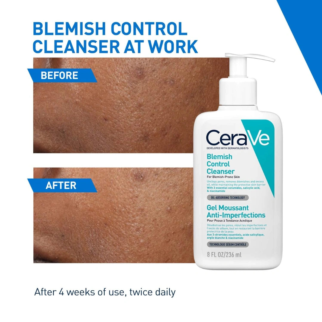 CeraVe Blemish Control Cleanser with 2% Salicylic Acid & Niacinamide for Acne Prone Skin, Controls Acne & Spots, Unclog Pores & Reduces Blemishes, 236ml