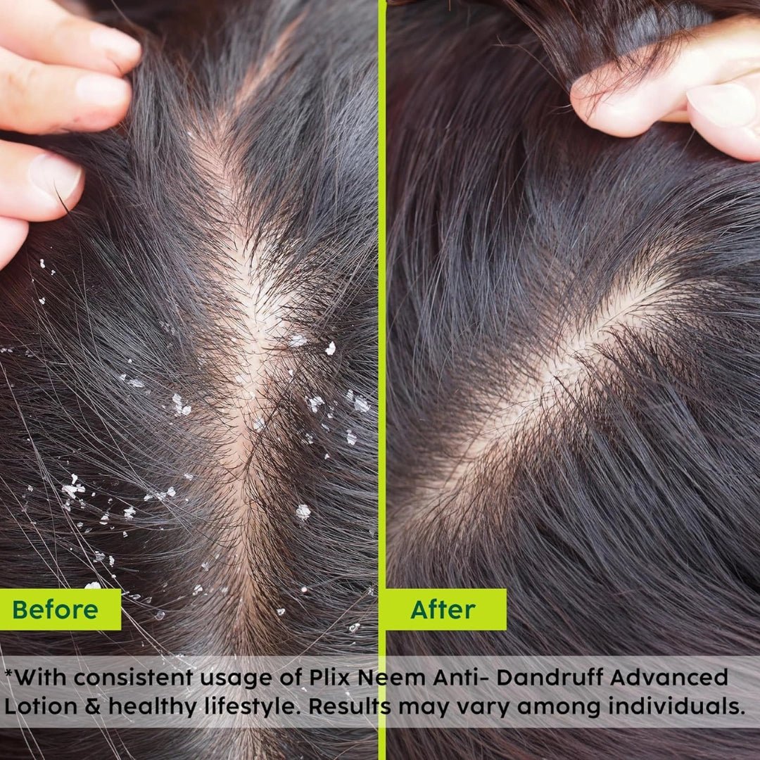 The Plant Fix Plix Neem Anti - Dandruff Advanced Lotion | Reduce Dandruff, Itching & Irritation | With Dandelix Pro & Ichthyol PALE | Paraben & Sulphate Free | Unisex (60ml) - Deals999