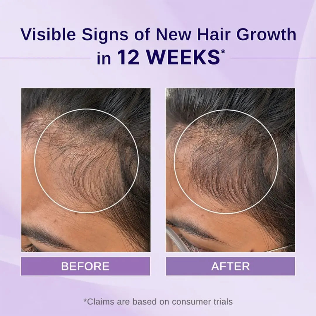 Bare Anatomy Nature x Science Rosemary Hibiscus Hair Growth Oil for Women & Men (100ml)