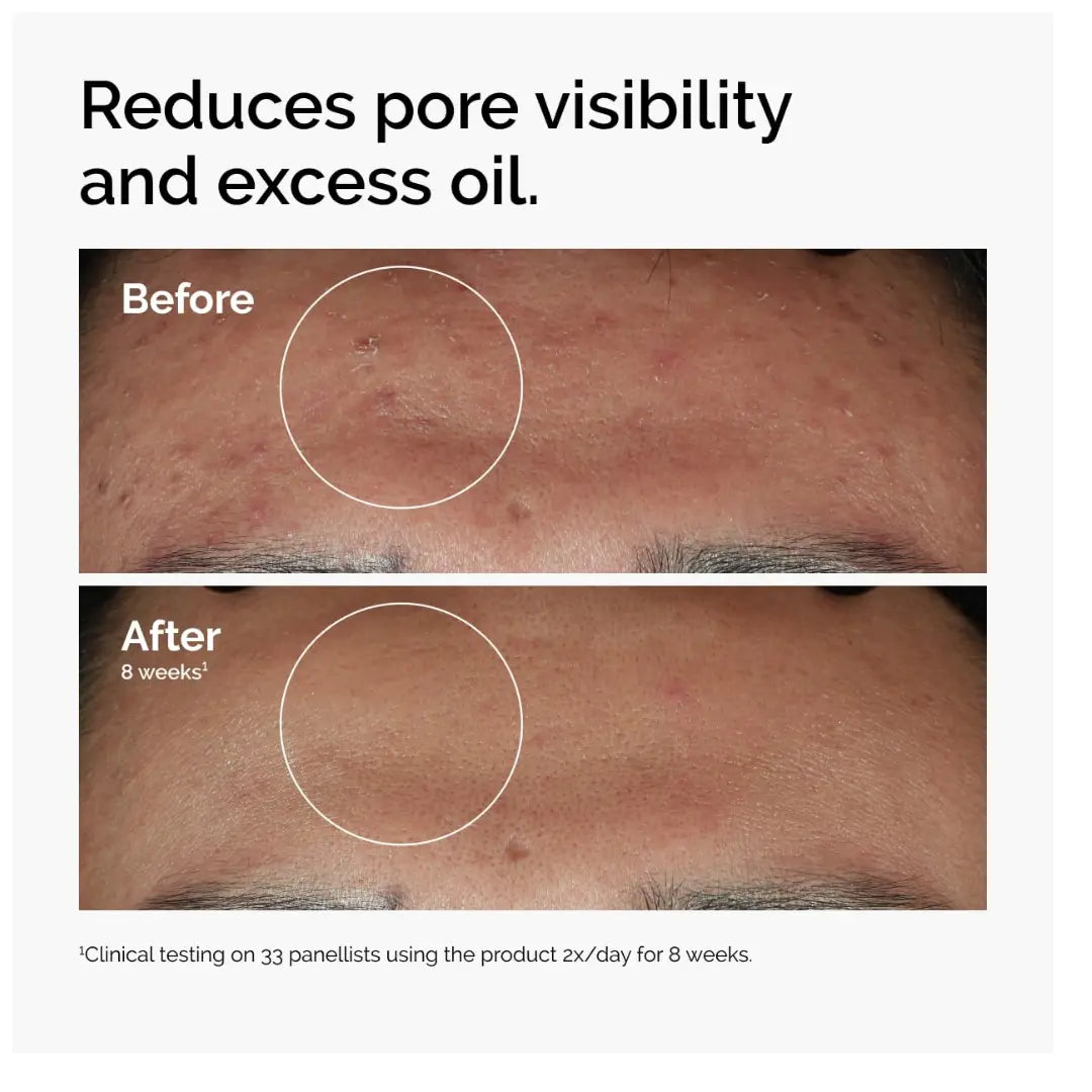 The Ordinary Niacinamide 10% + Zinc 1%, Brightening & Smoothing Serum for Blemish-Prone Skin