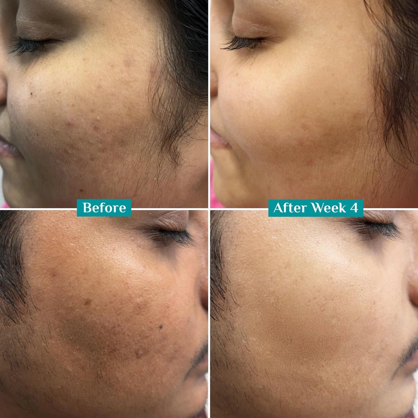 Pilgrim 10% Vitamin C Serum 30ml for Glowing Skin|With 5% Niacinamide, Hyaluronic & Glycolic Acid|Fades Dark Spots, Pigmentation|For All, Oily, Combination, Normal Skin |Beginner Friendly - Men, Women - Deals999