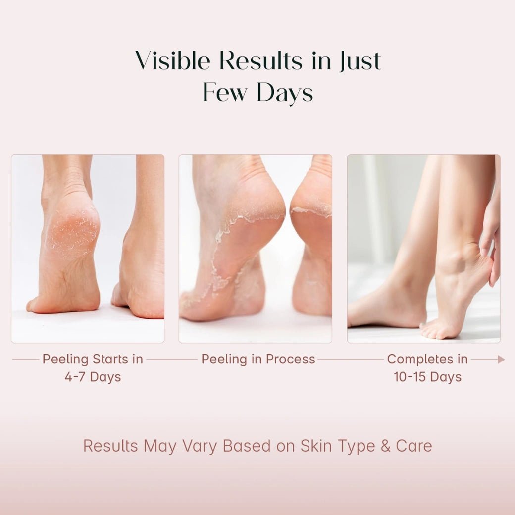 SeoulSkin Glycolic Acid Foot Peeling Mask (1 Pair), Korean Peeling & Exfoliating | Deep Exfoliation with Glycolic Acid, Removes Dead Skin, Cruelty-Free, Foot Peel Off Mask - Deals999